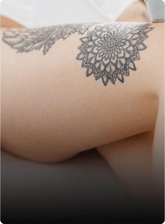 Saline Tattoo Removal