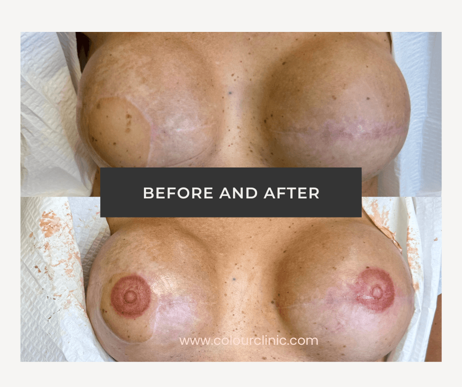 Breast cancer survivors photo after having a 3D nipple tattoo treatment at the Colour Clinic in Oakville.