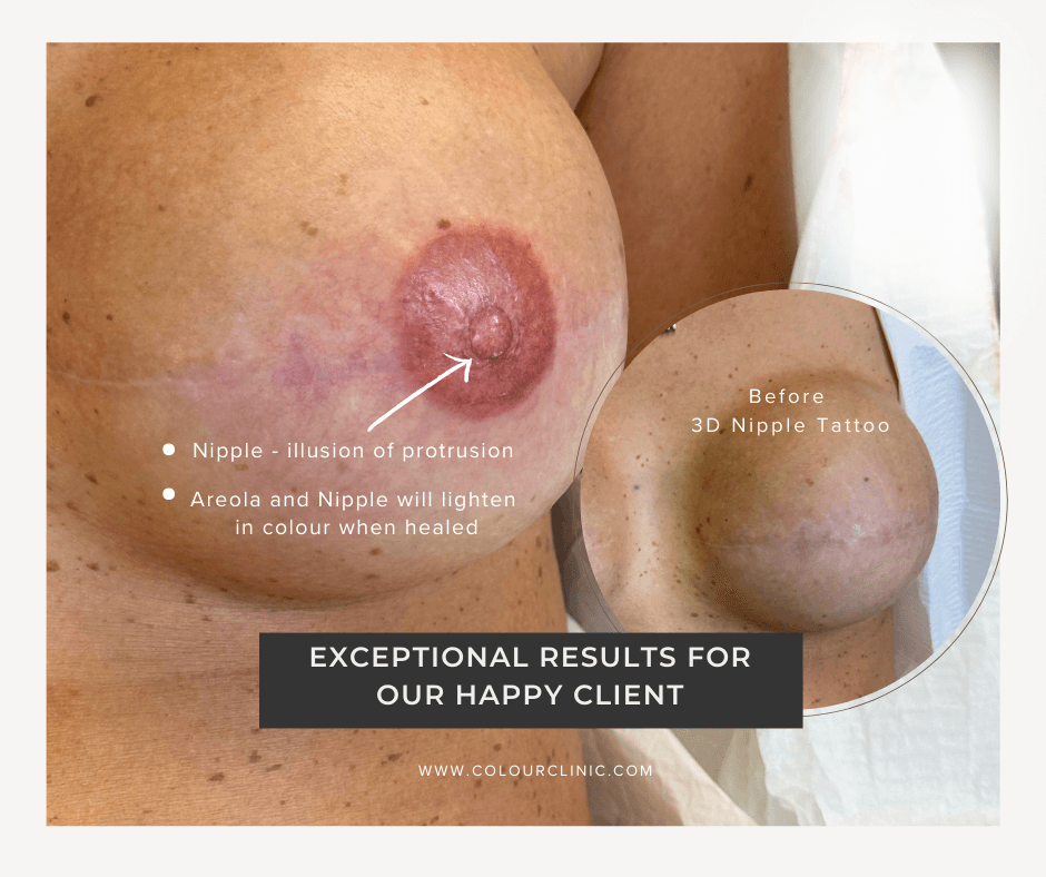 3D nipple tattoo performed by Marcie McManus at the Colour Clinic in Oakville, Ontario.