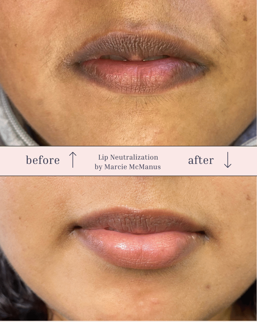 Before and after of healed lip neutralization showing natural, even-toned lips